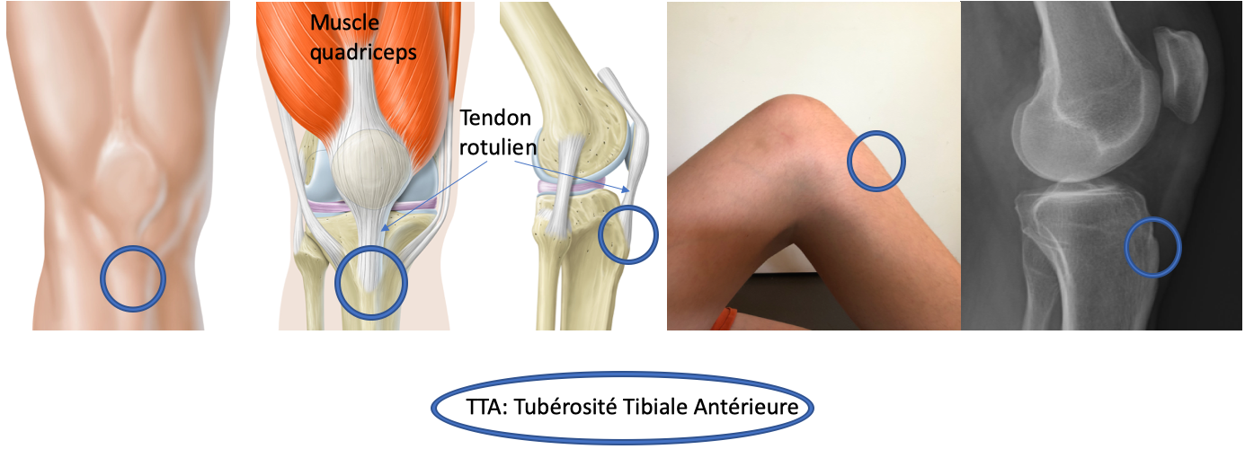 Maladie d'Osgood-Schlatter : symptômes et traitement | NCJS