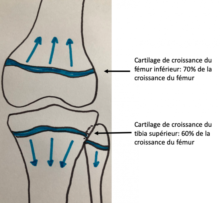 Rupture du ligament croisé antérieur chez l