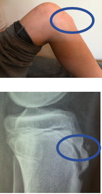 Maladie d'Osgood-Schlatter : symptômes et traitement | NCJS