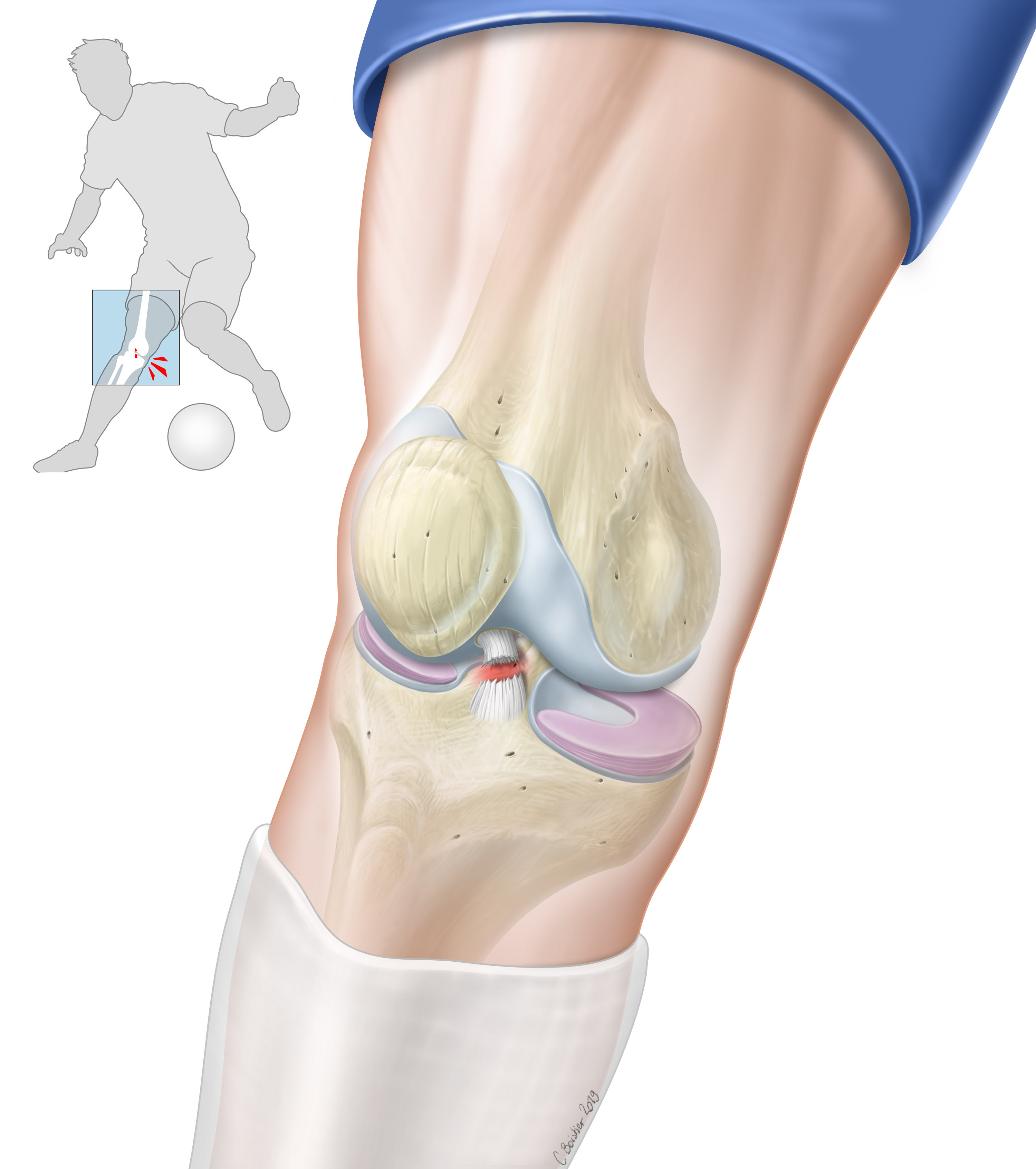 Rupture du Ligament Croisé Antérieur : causes, symptômes et ...