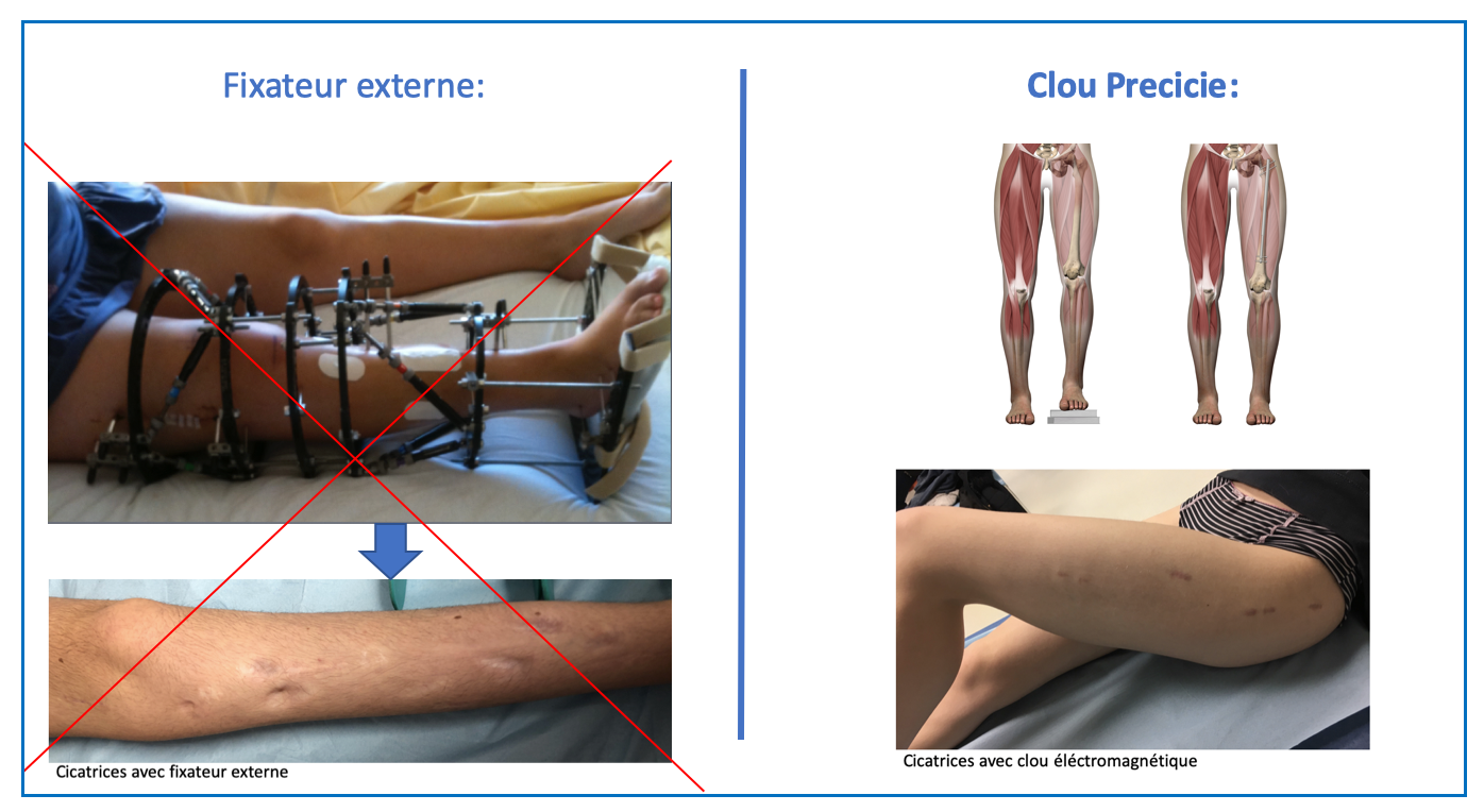 allongement osseux progressif clou magnétique PRECICE