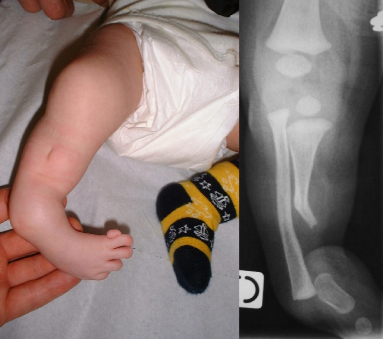 inégalité de longeur et malformations membre inférieur