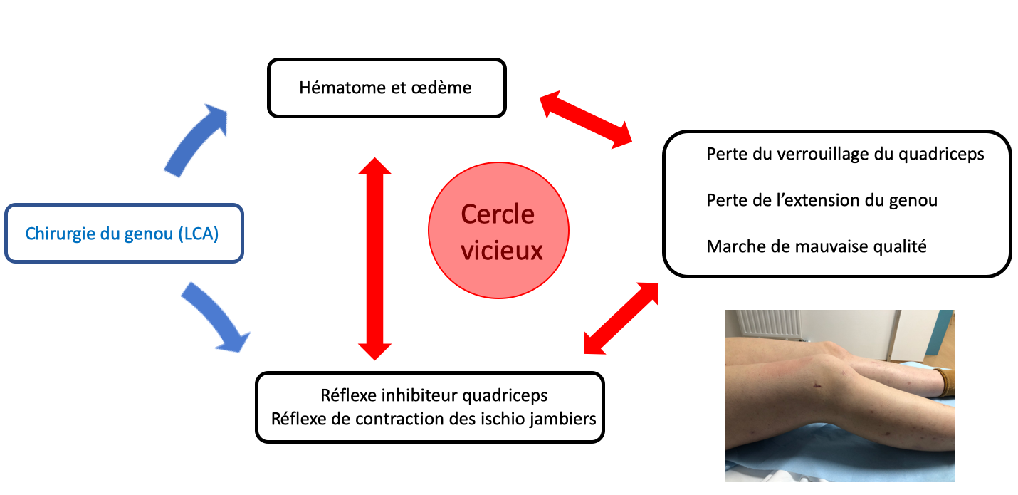 arthrogenic-muscle-inhibition