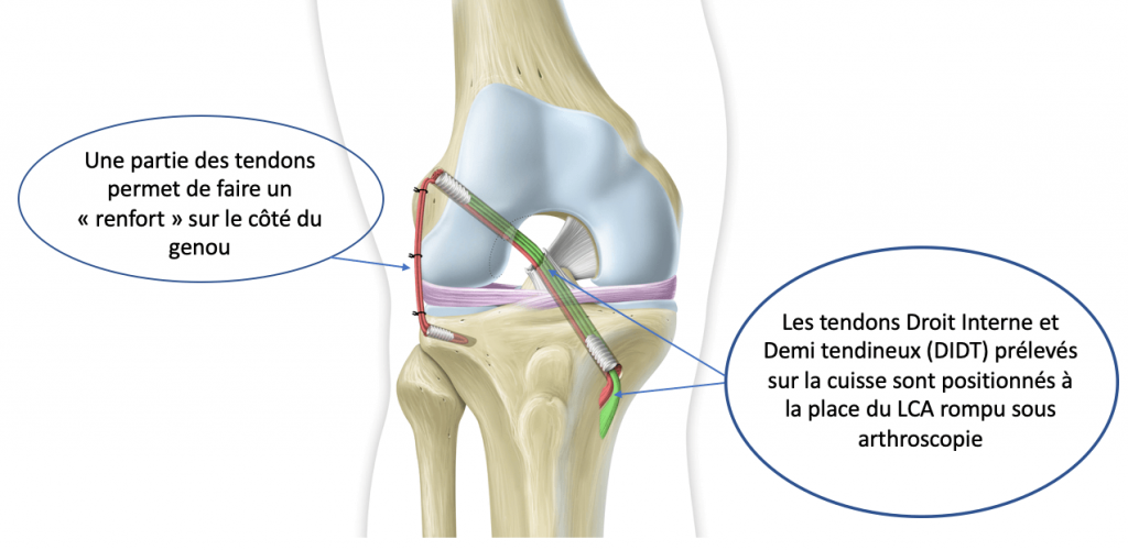 Instabilité et luxation de rotule - Nantes Chirurgie Jeunesse et Sport